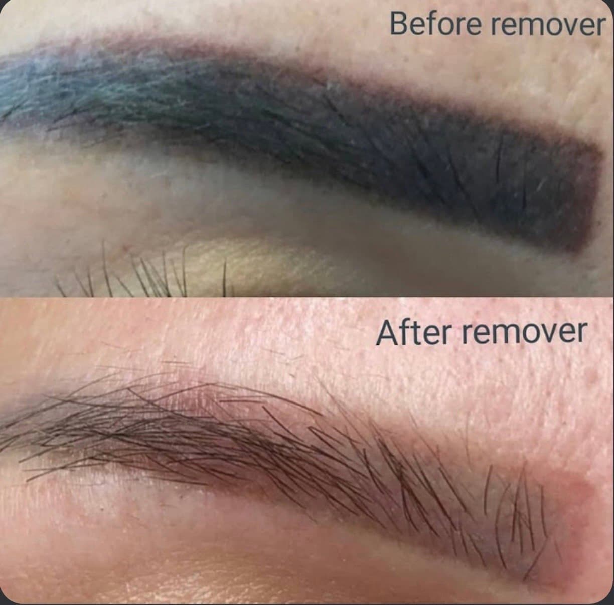 Brow correction result