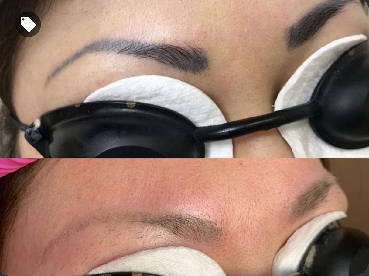 Brow correction result